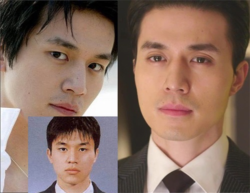 Lee Dong-wook’s Double Eyelid Surgery